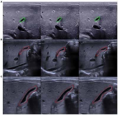 Is the diagnostic model based on convolutional neural network superior to pediatric radiologists in the ultrasonic diagnosis of biliary atresia?